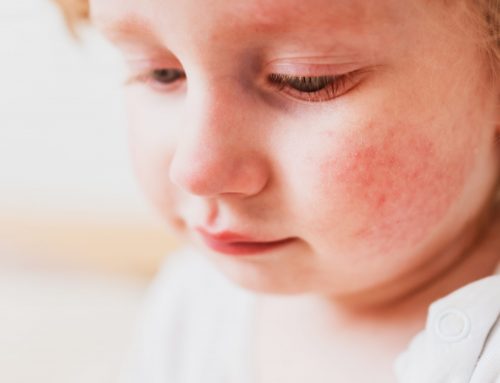 ¿Dermatitis atópica, sabes que es y como se cuida?