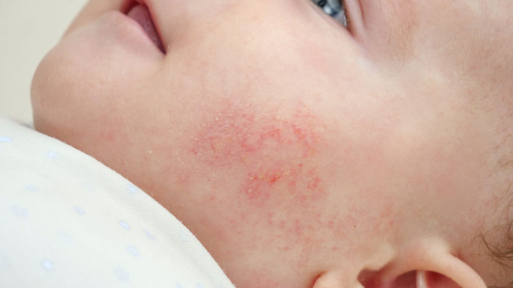 Dermatitis atopica en bebes