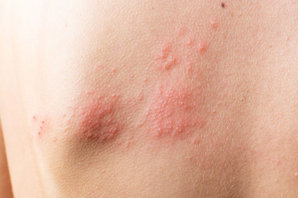 Dermatitis atópica en adulto